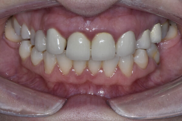 Before